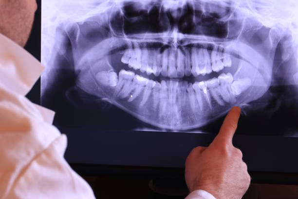Best Emergency Dentist for Lost Fillings or Crowns in Greenhills, OH
