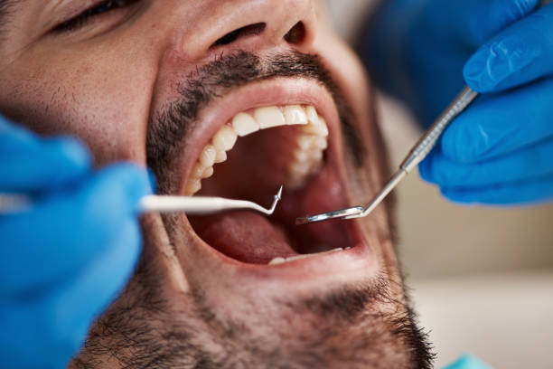 Best Emergency Dental Extractions in Greenhills, OH